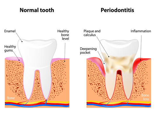 Non-surgical periodontal therapy 