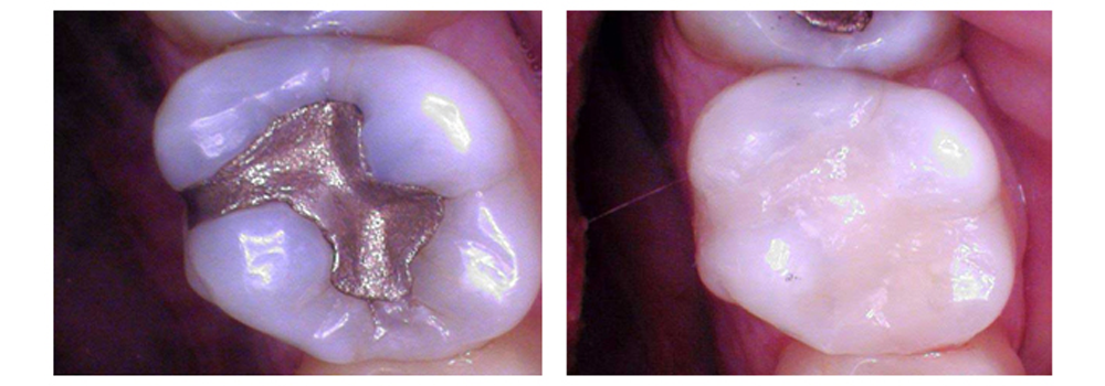 Tooth colored Fillings 